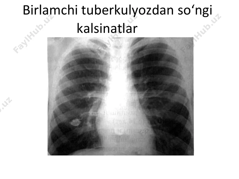 o'choqli tuberkulyoz infiltratsiya davri - Page 3