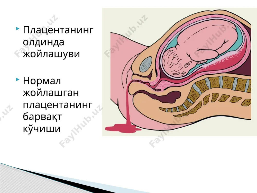 инча пульс аниқланмаса тўғри бажарилаётганлигини билдиради. қорин аортасини босиш қон кетиш тўхтагунга қадар бажарилади. қон кетишни эрта аниқлаш ва ёрдамга чақириш аёл холатини бахолаш ва ёрдам кўрсатиш йўқотилган қон миқдорини аниқлаш хар бир дпм қон кетишда ёрдам кўрсатиш ва унинг олдини олишда ўзининг миллий протоколига эга бўлиши бу протокол қўлланмаларга асосланган ва илмий исботга эга бўлиши шарт хулоса 15 хеч қачон аёлни бир ўзини қолдирманг, қачонки ахволи тикланмагунча ва қон кетиши тўхтамагунча. атоник ткқ да хеч қачон қин тампонларини ишлатманг сиз уйда бўлсангиз ёки малакали ёрдам бера олмайдиган муассасада бўлсангиз, беморни махсус марказларга ўтказиш зарурати бўлади агар: бемор шок холатида бўлса қон кетиши тўхтамаса йўлдош бўлакларини олиб ташлаш учун тозалаш керак. имконият борича энг тез транспорт воситасини ишлатинг. эсда тутинг эътиборингиз учун рахмат image2.png image3.png image4.png image5.png image6.jpeg image7.png image8.png image9.png image1.jpeg /docprops/thumbnail.jpeg