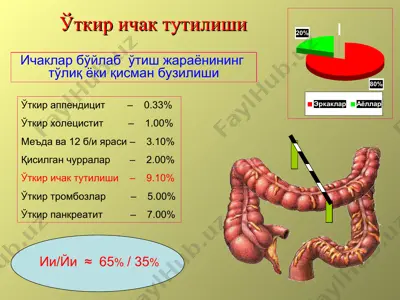 ўткир ичак тутилиши — PPT