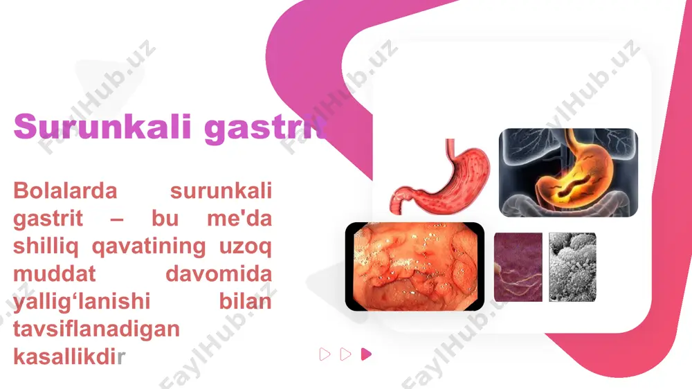 rda uchraydi, asosan 5-14 yosh oralig'ida. etiologiyasi infeksion omillar: helicobacter pylori infeksiyasi oziqlanish: noto'g'ri va balanssiz ovqatlanish, qattiq va o'tkir taomlar iste'moli dori-darmonlar: antibiotiklar, nsar (non-steroid yallig'lanishga qarshi dorilar) genetik moyillik: ota-onalarda oshqozon yoki ichak kasalliklari patogenezi oshqozon va o'n ikki barmoq ichakning shilliq pardasida yallig'lanish jarayoni yuzaga keladi. h. pylori infektsiyasi kislotali muhitda ko'payib, shilliq pardaga zarar yetkazadi. oshqozon kislotaliligining oshishi va shilliq pardaning himoya xususiyatlarining susayishi yallig'lanishning davom etishiga olib keladi. klinikasi qorin og'rig'i (epigastriyadagi og'riq, ayniqsa ovqatdan so'ng) ko'ngil aynishi, qusish ishtahaning yo'qolishi diareya yoki konstipatsiya charchoq, og'irlik sezishi ba'zan aritmiya yoki achishish diagnostikasi laboratoriya tekshiruvlar: h. pylori aniqlash (breath test, serologiya, pcr) qon tahlili (anemiya, ) endoskopiya (gastroskopiya): shilliq parda eroziyasi yoki yallig'lanishi biopsiya: o'zgarishlarni aniq tasdiqlash uchun surunkali gastroduodenitni davolash 1. etiologik davolash h. pylori infektsiyasi: antibiotiklar (amoksitsillin, klaritromitsin). ppi (omeprazol, lansoprazol). 2. simptomatik davolash antatsidlar: almagel, maalox. sekretor boshqaruv: ranitidin, famotidin. shilliq qavatni tiklash: …
