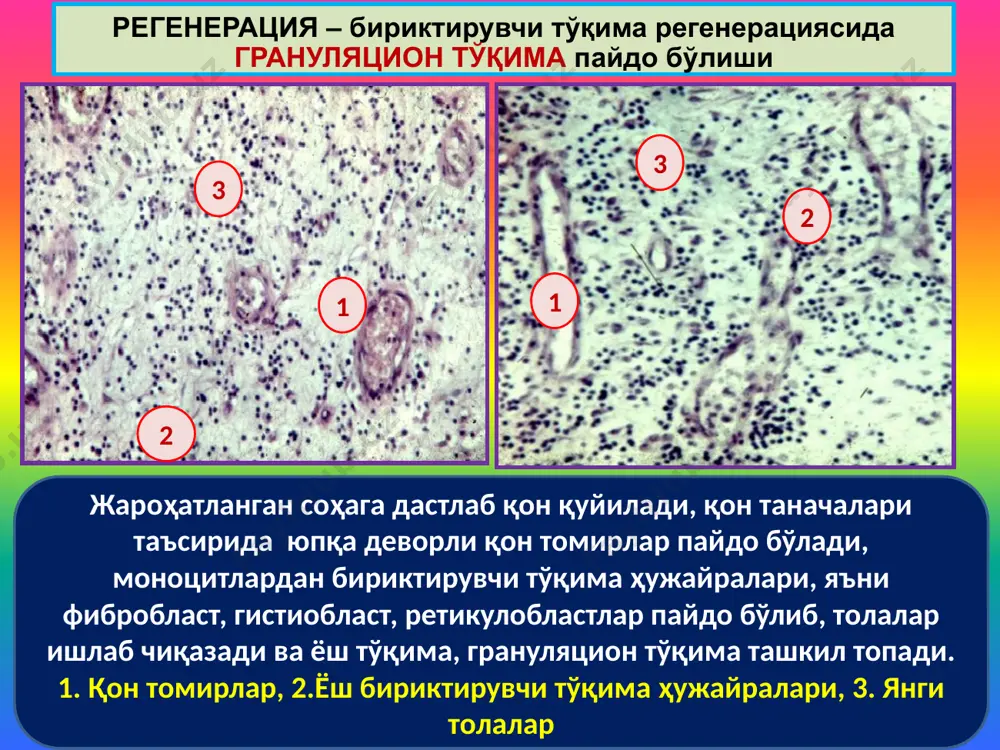 топишининг издан чиқишидир. дисплазия 4 хил патологик ўзгаришлар билан намоён бўлади: 1.анизоцитоз – ҳужайралар ўлчами бўйича ҳар хил 2.пойкилоцитоз – ҳужайралар аномал шаклда 3.гиперхроматоз – ҳужайралар пигментланиши аномалияси 4. ҳужайралар митотик фаоллашувидаги аномалиялар. эпителий ҳужайралар дисплазия даражалари: 1.суст даража – эпителий ҳужайралар ядролари тўқлашади (гиперхромазия) ва йириклашади 2. ўртамиёна – эпителий ядролари ўлчамида ҳар хиллик пайдо бўлади 3. кучли ёки оғир дисплазия – ядролар тўқ ва ўлчами ҳар хил, ядрочалар ва митозлар кўпайган. 4. атипик дисплазия – ҳужайралар шакли ва формаси бўйича ўзи пайдо бўлган ҳужайраларга ўхшамайди, полиморф шаклда дисплазия image1.wmf image2.png image3.jpeg image4.jpeg image5.jpeg image6.png image7.jpeg image8.jpeg image9.jpeg image10.png image11.png image12.png image13.jpeg image14.png image15.jpeg image16.png image17.png image18.png image19.png /docprops/thumbnail.jpeg
