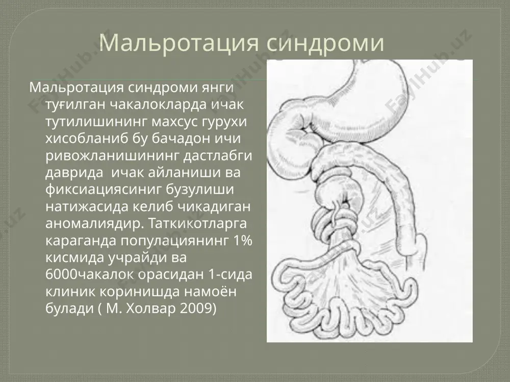 мальротация синдроми - Page 5