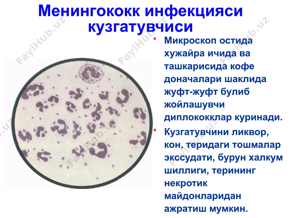 да некрозлар кучади ва чандиклар хосил булади. тошманинг кайта ривожланиши зараланишнинг кенглиги ва характерига боглик. розеолез-папулез тошмалар 1-3 кундан сунг изсиз йуколади, чукур некроз сохаларида узок вакт битмайдиган яралар хосил булади. 3-7 % холларда бугимлар зараланиши – артритлар кузатилади. увеитлар, хамда бошка аъзо ва тизимларнинг зараланиши хам кузатилиши мумкин. менингококцемиянинг клиник куринишлари менингококцемия менингококкцемиядаги тошмалар менингококемиянинг огирлик мезони огирлик буйича: енгил, урта огир огир шакли. огирлик мезони : токсикоз симптомнинг намоенлиги хушнинг узгариши тана хароратининг даражаси геморрагик- некротик тошманинг куплиги ва размерлари менингококкемиянинг яшинсимон кечадиган шакли - (ута уткир менингококкли сепсис) касаллик уткир, тусатдан харорат кутарилиши 39-40•с билан бошланади, калтираш, эт увишиши, купгина геморрагик тошиши билан намоенланади, катта кисмига кон куйилиш кузатилади, аб тушади, кон айланиш етишмовчилиги, двс, мушаклар гипотонияси, талвасаланиш ривожланади. бу шакл инфекцион-токсик шок деб бахоланади. адекват ва уз вактида даво чоралари олиб борилмаса 12-24 соатдан кейин улим юзага келиши мумкин. купинча бу касалликнинг биринчи соатларида буйрак усти …