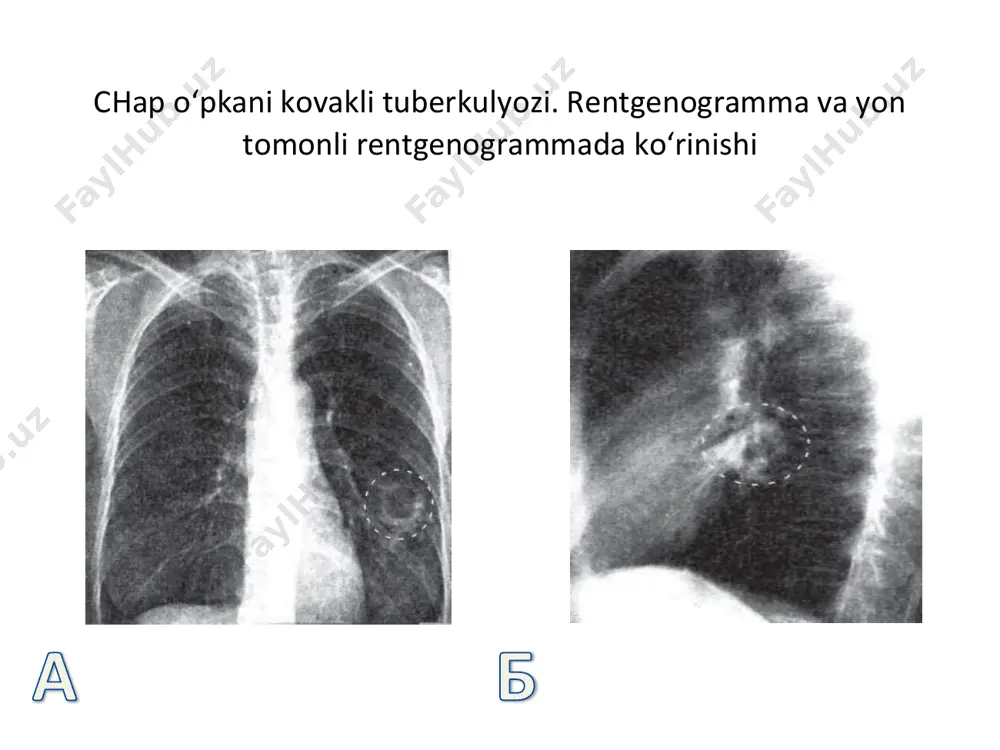 o‘ng o‘pkani kovakli tuberkulezi - Page 4