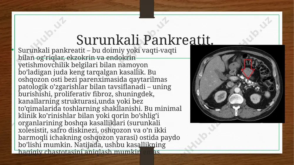 a’zida oshqozon osti bezi boshidagi sklerotik jarayonlar o’t yo’llari va oshqozon osti bezi kanalining siqilishiga o’xshash klinik ko’rinishga olib keladi. xuddi shunday ko’rinish oshqozon osti bezi boshining o’smalarida kuzatiladi, shuning uchun pankreatitning bu shakli psevdotumor deb ataladi. bunday hollarda safro chiqishi buzilishi obstruktiv sariqlikka olib kelishi mumkin. surunkali pankreatit fonida o’tkir pankreatit paydo bo’lishi mumkin, bu surunkali pankreatitning kuchayishi bilan teng emas. oshqozon-ichak traktining buzilishidan tashqari, surunkali pankreatit bilan og’rigan bemorlarda boshqa belgilar mavjud. 90% surunkali pankreatit bilan og’rigan bemorlarda mavjudligini tasdiqlovchi adabiy manbalar mavjud. polinevropatiyalar (periferik nervlarning funksional o’zgarishlari bilan bog’liq) holatlarining. diagnostika. surunkali pankreatitni tashxislash uchun standart tekshiruvdan tashqari, oshqozon osti bezining ekzokrin funksiyasi ham muhimdir. buni koprogram yordamida aniqlash mumkin (najasdagi hazm bo’lmagan oziq-ovqat qoldiqlarini mikroskopik tahlil qilish). instrumental tadqiqotlar ham qo’llaniladi: qorin bo’shlig’i organlarining ultratovush tekshiruvi, qorin bo’shlig’i organlarining kompyuter tomografiyasi va boshqalar. bemorlar chapqovurg’a osti sohasida zerikarli og’riqli og’riqlardan shikoyat qiladilar, ular boy va yog’li …