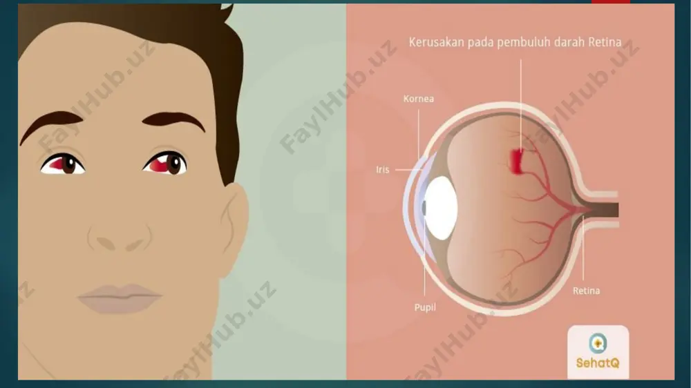 diabetik retinopatiya - Page 4