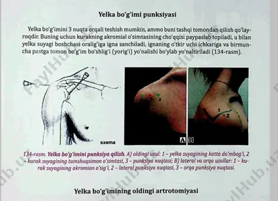 yelka bo‘g‘imi punksiyasi — PDF