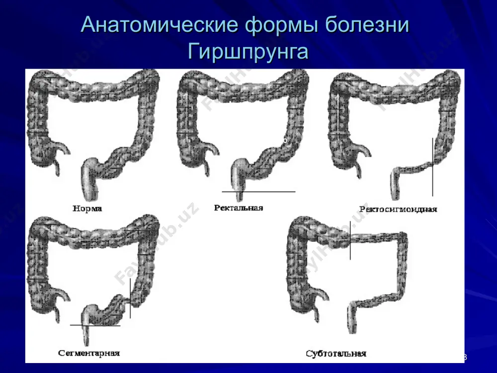 иглорефлексотерапию, лечебную физкультуру направленную на укрепление мышц тазового дна. 3. магнитотерапия и баллонная дилатация низведенной кишки с целью формирования ампулярной зоны воссозданной прямой кишки. * болезнь гиршспрунга, ректосигмоидная форма расширенная ободочная кишка переходит в суженую сигмовидную кишку аноректальные пороки развития аноректальные пороки развития – составляют одну из наиболее многочисленных групп проктологических заболеваний детского возраста. их частота, по данным разных авторов, колеблется от 1:500 до 1:5000 живых новорожденных независимо от пола (santuni t.v., 1965; churhili b, et al., 1979). у мальчиков чаще встречается атрезия с ректоуретральным свищом, у девочек - с ректовестибулярным свищом (a.pena, 1988). диагностика аноректальных пороков развития базируется на данных; осмотра, пальпации; инструментальных методов исследования; по пелерину - ситковскому, ленюшкину, рентгенологический метод по вангенстину - каковичу – райсу; при свищевых формах используется ирригография, макро и микроскопические анализы мочи, фистулография, уретероцистография. атрезия ануса, расщепление мошонки, гипоспадия, ректопромежностный свищ промежностная эктопия анального канала atresia ani ректопромежностный свищ ректо-промежностный свищ. гипертрофированный анальный …