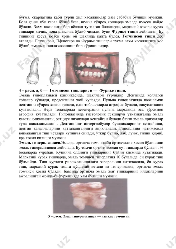 саллигига хос бўлиб, эмаль гипоплазиясининг бир кўринишидир. 4 – расм. а, б — гетчинсон тишлари; в — фурнье тиши. эмаль гипоплазияси клиникасида, шакллари турлидир. дентинда коллаген толалар кўпаяди, предентинга жой кўпаяди. пульпа гипоплазияда иккиламчи дентинни кўпроқ хосил қилади, одонтобластларда атрофия булади, вакуолизация кузатилади.. нерв толаларида дегенерация пульпа марказида эса тўрсимон атрофия кузатилади. гипоплазияда гистологик текширув ўтказилганда эмаль қавати юпқалашган, ретциус чизиқлари кенгайган булади баъзи эмаль призмалар тула шаклланмаган . дентиннинг интерглобуляр бушликларнинг кенгайиши, дентин каналчаларини катталашганлиги аникланади. гипоплазия натижасида юпкалашган тиш четлари кўпинча синади, ўткир бўлиб, лаб, лунж, тилни қириб, яра хосил қилиши мумкин. эмаль гиперплазияси.эмалда ортиқча томчи каби ортиқчалик хосил бўлишини эмаль гиперплазияси дейилади. бу томчи ортиғи асосан сут тишларда бўлади.. % болаларда учрайди. кўпинча олдинги тишларнинг бўйин кисмида кузатилади. марказий курак тишларда, эмаль томчиси гиперлазия 10 бўлагида, ён курак тиш бўлмайди. тиш куртаги ривожланишидаги зарарланиш натижасида, ён курак тиш, марказий курак тишга қўшилиб кетади ва гиперплазия, ортиқча эмаль …