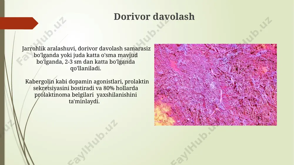 ta'sir qilishi mumkin. qon tahlillari prolaktinoma sindromida prolaktin darajasining 20 ng/ml dan yuqori boʻlishi diagnostika mezonlaridan biri hisoblanadi va qon tahlillari natijalarida aniqlanadi. prolaktinomani boshqa gipopituitarizm holatlaridan farqlash uchun qon tahlillari orqali kortizol, acth va gonadotropinlarning darajalari tekshiriladi, bu 80% hollarda aniq tasdiqlashga imkon beradi. prolaktinomoning tashxisi bemorlarda galaktoreyani (sut ajralishi), amenoreyani (hayz ko'rishning to'xtashi) va gipogonadismni aniqlash prolaktinomaning klinik belgilarini aniqlashda muhimdir, bu alomatlarning birgalikda uchrashi prolaktinoma ehtimolini oshiradi. prolaktinoma tashxisida qon zardobida prolaktin darajasining 20 ng/ml dan yuqori boʻlishi, shu bilan birga miya magnit-rezonans tomografiyasi (mrt) yordamida gipofiz bezida oʻsma aniqlanishi muhim ahamiyatga ega. prolaktinomoning sabablari prolaktinoma rivojlanishiga 20% hollarda irsiy omillar, genetik mutatsiyalar sabab boʻlishi mumkin, bu esa prolaktin ishlab chiqarishni tartibga soluvchi genlarning ishlashini buzadi. gipotalamusning disfunktsiyasi, masalan, crh yoki dopamin ishlab chiqarishining buzilishi, prolaktin sekresiyasini nazorat qilish mexanizmlarini susaytirib, prolaktinomani keltirib chiqarishi mumkin. prolaktinomoning alomatlari erkaklarda prolaktinoma gipogonadotropik gipogonadizmga olib kelishi mumkin, bu esa libido …