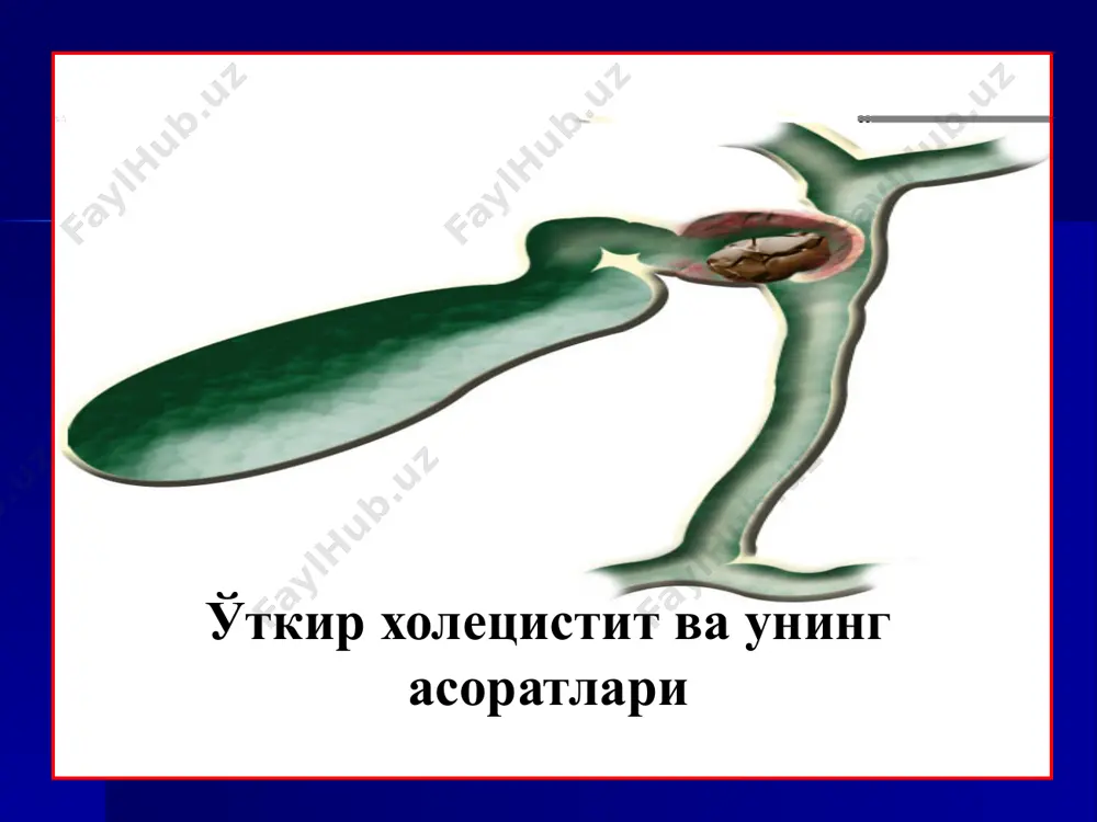 ташқи блок) инфекция ўт қопи артериясининг тромбози жароҳатлар иккиламчи яллиғланиш ўткир холецистит этиопатогенези ўткир холециститнинг клиник манзараси субъектив белгилар: ўнг қовурға равоғи остида оғриқ оғриқ иррадиацияси кўнгил айниши оғизда аччиқ таъм ва қуриши жиғилдон қайнаши қайт қилиш оғриқнинг овқат билан боғлиқ лиги қориннинг дам бўлиши объектив белгилар катталашган ўт қопи қорин девори таранглиги симптомлар: мерфи, мюсси, греков-ортнер, рефлектор стенокардия температура ортиши лейкоцитоз эчт нинг ортиши диагностикаси ноинвазив ультратовушли текширув рентгенография компьютер томография магнит-резонанс томография инвазив усуллар анте- и ретроград холангиография лапароскопия қалинлашган девор ва паравезикуляр йиринг ўт қопи бўйинчасидаги тош ўткир холециститда утт манзараси асоратланган ўткир холецистит утт паравезикуляр абсцесс паравезикуляр инфильтрат компьютер томография конкрементлар ўт қопи ўткир гангреноз холецистит ўткир холецистит лапароскопик кўриниши эндоскопик ретроград холангиопанкреатикография (эрпхг) антеград холангиография (тжохг) ўткир холецистит асоратлари перфорация ва ўтли перитонит, йирингли холангит, синдром мириззи, билиодигестивные оқма, холедохолитиаз, механик сариқлиқ, ўткир панкреатит, жигар етишмовчилиги холедохолитиаз. механик сариқлиқ мириззи синдроми ўт йўли стриктураси ўткир …
