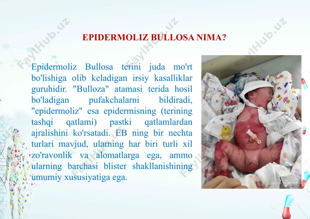 ·og'iz va qizilo'ngach bilan bog'liq muammolar: og'iz va qizilo'ngachda ham pufakchalar paydo bo'lishi mumkin, bu esa ovqatlanish va yutishda qiyinchiliklarga olib keladi. klinik baholash epidermoliz bullosa tashxisi odatda to'liq klinik baholash bilan boshlanadi. tibbiy xizmat ko'rsatuvchi provayderlar bemorning batafsil tarixini, shu jumladan oila tarixini oladi va teri lezyonlarining darajasi va tabiatini baholash uchun fizik tekshiruv o'tkazadi. tashxis testlari eb tashxisini tasdiqlash uchun bir nechta diagnostik testlardan foydalanish mumkin: ·teribiopsiyasi: eb ning o'ziga xos turini aniqlash uchun terining kichik namunasi olinadi va mikroskop ostida tekshiriladi. ·genetika testi: bu eb bilan bog'liq genlardagi mutatsiyalarni aniqlashi mumkin, tashxisni tasdiqlaydi va turini aniqlashga yordam beradi. ·immunofluoresan mikroskopiya: ushbu test terining yopishishida ishtirok etadigan oqsillarni ko'rishga yordam beradi. davolash hozirda epidermoliz bullozasini davolamasa-da, bir nechta davolash usullari simptomlarni boshqarishga va hayot sifatini yaxshilashga yordam beradi: ·yaralarni davolash: yarani to'g'ri parvarish qilish infektsiyani oldini olish va davolanishni tezlashtirish uchun juda muhimdir. bu maxsus kiyinish va topikal …