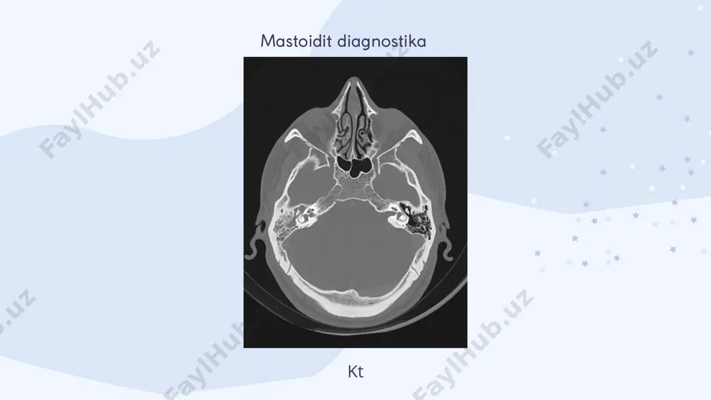 antrit va mastoidit differensial diagnostika - Page 5