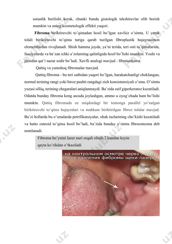 ; · ingichka oyoqchada yumshoq konsistensiyali fibropapillomadan. fibropapilloma yuzasi ajinlangan, biroz pigmentli va terida tuklar yo’qligi bilan farqlanadi. fibropapillomadan farqli, yumshoq fibroma ingichka oyoqchada kolba shaklida osilib turadi. davolash mahaliy infiltratsion anesteziya ostida jarrohlik, yo’li bilan olib tashlanadi. shish to’liq olib tashlanmaganda u residivlanmaydi, lekin o’sishda davom etadi, bu esa takroriy jarrohlik aralashuvni nazarda tutadi. dermatofibroma-terining kollagen tolalaridan hosil bo’lgan xavfsiz o’sma. darrier - ferrandning bo’rtib chiqqan dermatofibrosarkomasi - xavfli analogi. dermatofibroma ayollarda ko’proq uchraydi. o’simta odatda ko’proq yuqori va pastki oyoq-qo’llar terisida, ammo tananing har xil qismida uchraydi. klinikasi. yumaloq shakldagi bitta yoki ko’plab tugunlar terida chuqur joylashadi, o’simta terida mustahkamlanganga o’xshaydi. palpatsiya paytida zich elastik konsistesiya seziladi. kichik o’lchamlarda o’simta teri bilan bir xil darajada joylashgan bo’lib, katta o’lchamlarda u yarim shar shaklida teri sathidan yuqoriga chiqadi, yarim doira pastki qismi yo’q. terining rangi to’q ko’k rangdan to’q jigarranggacha. o’simta o’lchamlari 2 mm dan 2,5 sm gacha. bu …