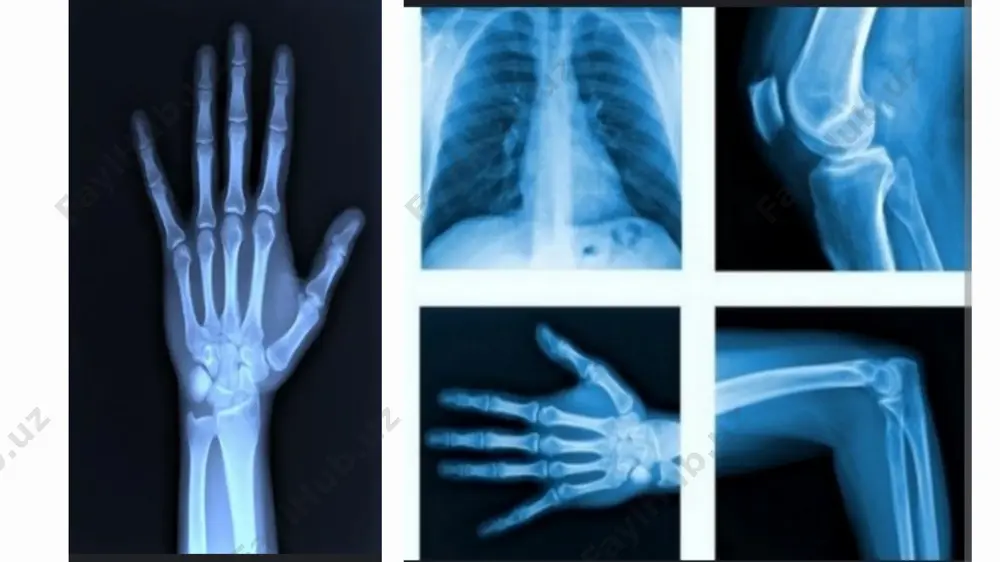 urli burchaklardan olingan bir nechta rentgen oʻlchovlari tomografik (kesimdagi) tasvirlarni (virtual „boʻlaklar“) ishlab chiqarish uchun tomografik rekonstruksiya algoritmlari yordamida kompyuterda qayta ishlaydi. magnit-rezonans tomografiya (mrt) kontrendikedir boʻlgan metall implantlar yoki yurak stimulyatori boʻlgan bemorlarda kompyuter tomografiyasidan foydalanish mumkin. 1970-yillarda ishlab chiqilganidan beri kt skanerlash koʻp qirrali tasvirlash usuli ekanligini isbotladi. kt tibbiy diagnostikada eng koʻp qoʻllanilsa-da, u tirik boʻlmagan obyektlarning tasvirlarini yaratish uchun ham ishlatilishi mumkin. 1979-yilda fiziologiya yoki tibbiyot boʻyicha nobel mukofoti janubiy afro-amerikalik fizik allan makleod kormak va britaniyalik elektrotexnika muhandisi godfrey xounsfildga „kompyuterli tomografiyani rivojlantirish uchun“ birgalikda berildi. kt aparatining turlar: ketma ket kt spiral kt. ikki energiyali kt. pektkt. ketma-ket kt bosqichli kt sifatida ham tanilgan ketma-ket kt bu kt stoli bosqichma-bosqich harakatlanadigan skanerlash usulining bir turi. kt stoli maʼlum bir joyga koʻtariladi, soʻngra rentgen trubkasi aylanishi va kesim olish bilan toʻxtaydi. keyin kt stoli yana suriladi va yana bir boʻlak olinadi. bu skanerlash vaqtini oshiradi …