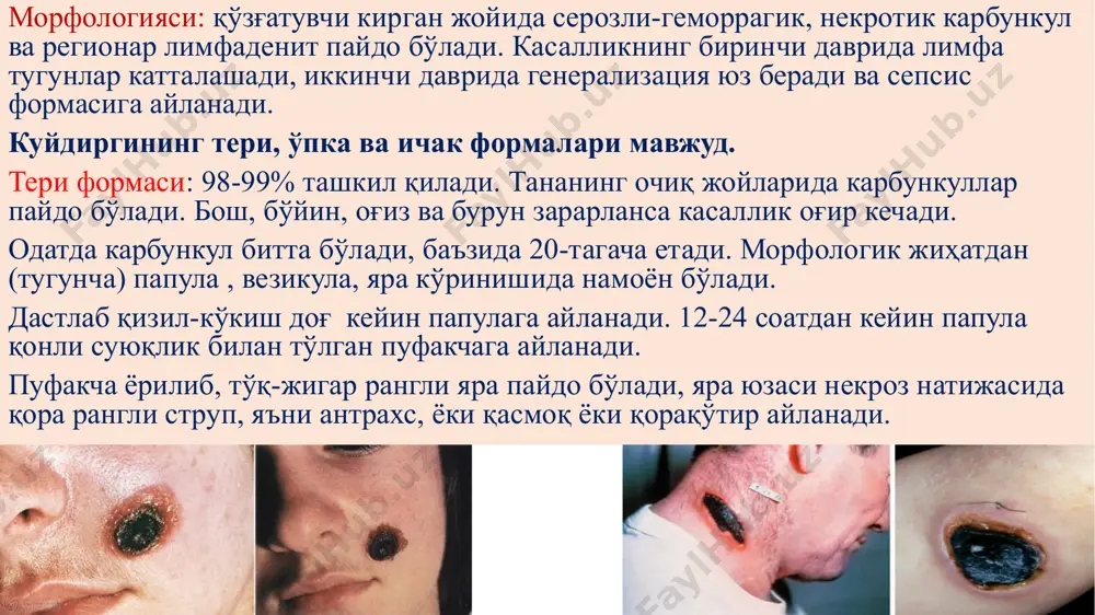 уттахавфли инфекциялар: геморрагик иситма - Page 5
