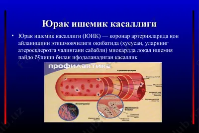 юрак ишемик касаллиги — PPT