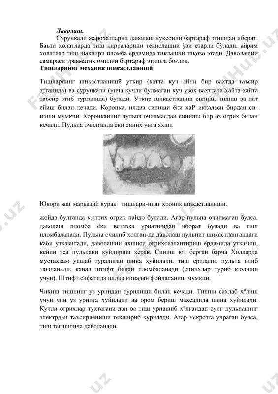 ади. уткир шикастланиш синиш, чихиш ва лат ейиш билан кечади. коронка, илдиз синиши ёки хар иккаласи бирдан си-ниши мумкин. коронканинг пульпа очилмасдан синиши бир оз огрих билан кечади. пульпа очилганда ёки синих унга яхши юкори жаг марказий курак тишлари-нияг хроник шикастланиши. жойда булганда к.аттих огрих пайдо булади. агар пульпа очилмаган булса, даволаш пломба ёки вставка урнатишдан иборат булади ва тиш пломбаланади. пульпа очилиб холган-да даволаш пульпит шикастлангандаги каби утказилади, даволашни яхшиси огрихсизлантириш ёрдамида утказиш, кейин эса пульпани куйдириш керак. синиш юз берган барча холларда мустахкам ушлаб турадиган шина хуйилади, тиш ёрилади, пульпа олиб ташланади, канал штифт билан пломбаланади (синихлар туриб к.олиши учун). штифт сифатида илдиз нинадан фойдаланиш мумкин. чихиш тишнинг уз урнидан сурилиши билан кечади. тишни сахлаб х°лиш учун уни уз урнига хуйилади ва ором бериш махсадида шина хуйилади. кучли огрихлар тухтагани-дан ва тиш урнашиб х°лгандан сунг пульпанинг электрдан таъсирланиши текшириб курилади. агар некрозга учраган булса, тиш тегишлича даволанади. тишларнинг …