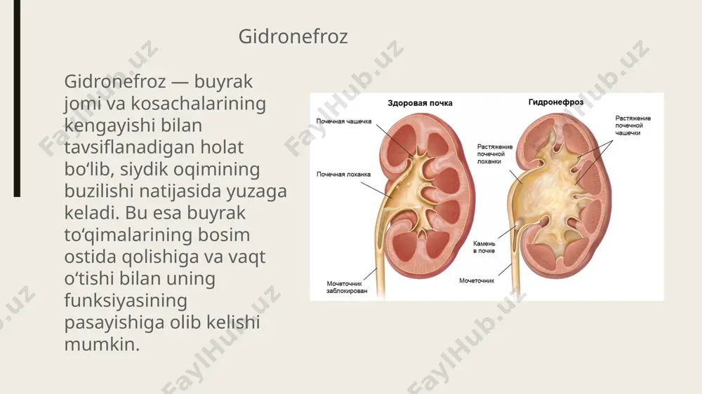 a antegrad pyelouretrografiya, dinamik nefrosintigrafiya), doplerosonogrfiya, endoluminal ultrasonografiya, kt, radioizotop va angiografik tadqiqotlar, uretropiyeloskopiya. instrumental diagnostika shikoyat (yonboshda og’riq, temperatura oshishi) anamnez (buyrak tosh operatsiyasi, gematuriya, temp periodik ko’tarilib turishi ko’ruv (yonboshda o’smasimon hosila, gipertermiya, gematuriya skring metod - siydik chiqaruv tizimini uzd buyrak hajmi, parenximasi, kosacha-jom tizimi diliatatsiyasi, konkrement bor yo’qligi, siydik pufagi holati, siydik pufagidagi qoldiq siydik, uretrosele prostata bezi hajmi, giperplaziyasi. ekskretor urografiya ekskretor urografiyaga qarshi ko’rsatma teri orqali nefrostomiya bilan antegrad pielouretrografiya obstruksiya darajasini bilish dinamik nefrosinsitografiya retrograd uretropielografiya obstruksiya sababini maxsus tekshiruv usullarida diagnozlash kt, mskt, mrt, uretroskopiya, nefroskopiya doplersonoografiya, endoluminal sonografiya digital subtraksion angiografiya ha yo’q davolash konservativ- faqatgina ushlab turuvchi terapiya hisoblanadi, bemorni baribir operatsiya qilish kerak antibiotik nsyq spazmolitik operativ ochiq rekonstruktiv operatsiya endourologik operatsiya-> percutan (teri orqali) va transuretral kirish mumkin laparoskopik va retroperitoneoskopik e'tiboringiz uchun rahmat image1.png image3.jpeg image4.png image5.jpeg image6.jpeg image7.jpeg image8.jpeg image9.jpeg