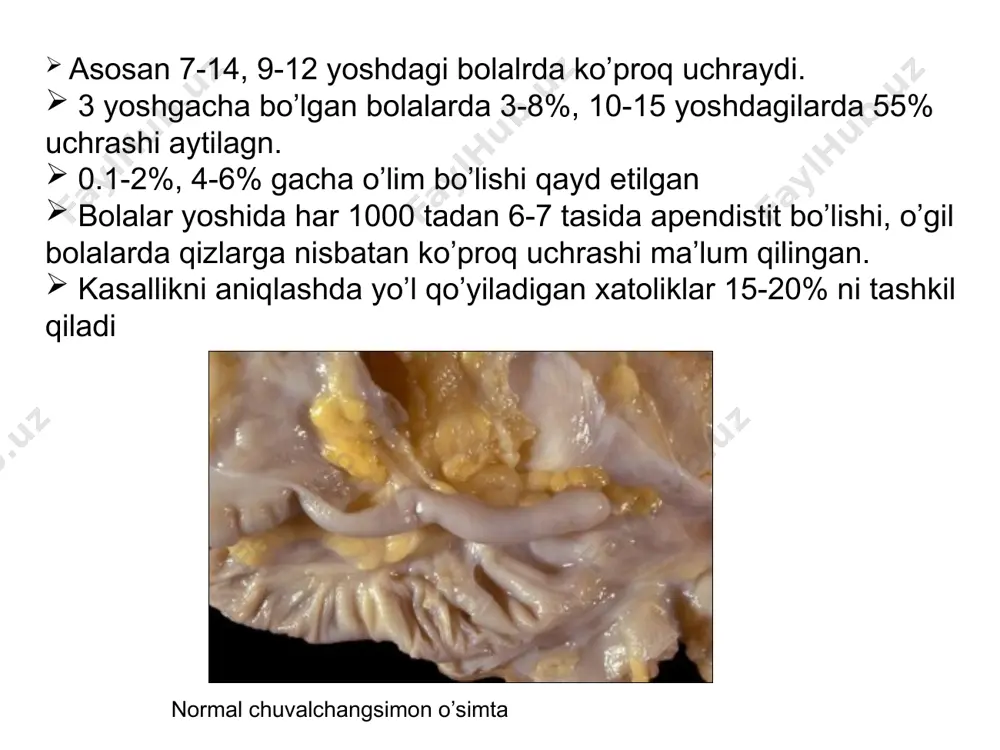 i) qorin o’ng bo’lagidagi ximoya (passiv) taranglashuvi qorin parda ta’sirlanishi (shetkin-blyumberg simptomi) o’tkirt apendistit kasalligida aniqlanadigan simptomlar. ўткир аппендицитни локал симптомлари воскресенский («кўйлак») – кўйлак устидан сирпанувчи ҳаракат қилганда ўнг ёнбош соҳада оғриқни кучайиши ровзинг – чап ёнбош соҳада перкуссия қилганда ўнг ёнбош соҳада оғриқнинг кучайиши раздольский – ўнг ёнбош соҳани перкуссиясида шу соҳада оғриқ бўлиши ситковский – чалқанча ётган ҳолатдан чап ёнбошга бурилаганда, ўнг ёнбош соҳада оғриқни кучайиши бартомье-михельсон – бемор чап ёнбошда ётганда, ўнг ёнбош соҳани пальпацияси оғриққа олиб келади кохер-волкович – оғриқни эпигастрийдан ўнг ёнбош соҳага кўчиши ўткир аппендицитни умумий симптомлари оғиз қуриши ва тилни оқ караш билан қопланиши тахикардия субфебрил температура эчт ошиши лейкоцитоз лейкофорулани чапга силжиши билан differensial diagnostikasi eiringli otit, tanzilit, o’bd, plevrapnevmoniya , gijja invaziyasi xolesistopatiya, pankreatit, infeksion gepatit, dizenteriya, revmatizm, buyrak sanchig`i, siedik tosh kasalligi, gemolitik pur-pura va boshqalar. qo’shimcha instrumental tekshirish usullari elektrotermometriya utt teplovidenie elektromiografiya laparoskopiya kt, mrt қорин бўшлиғини …