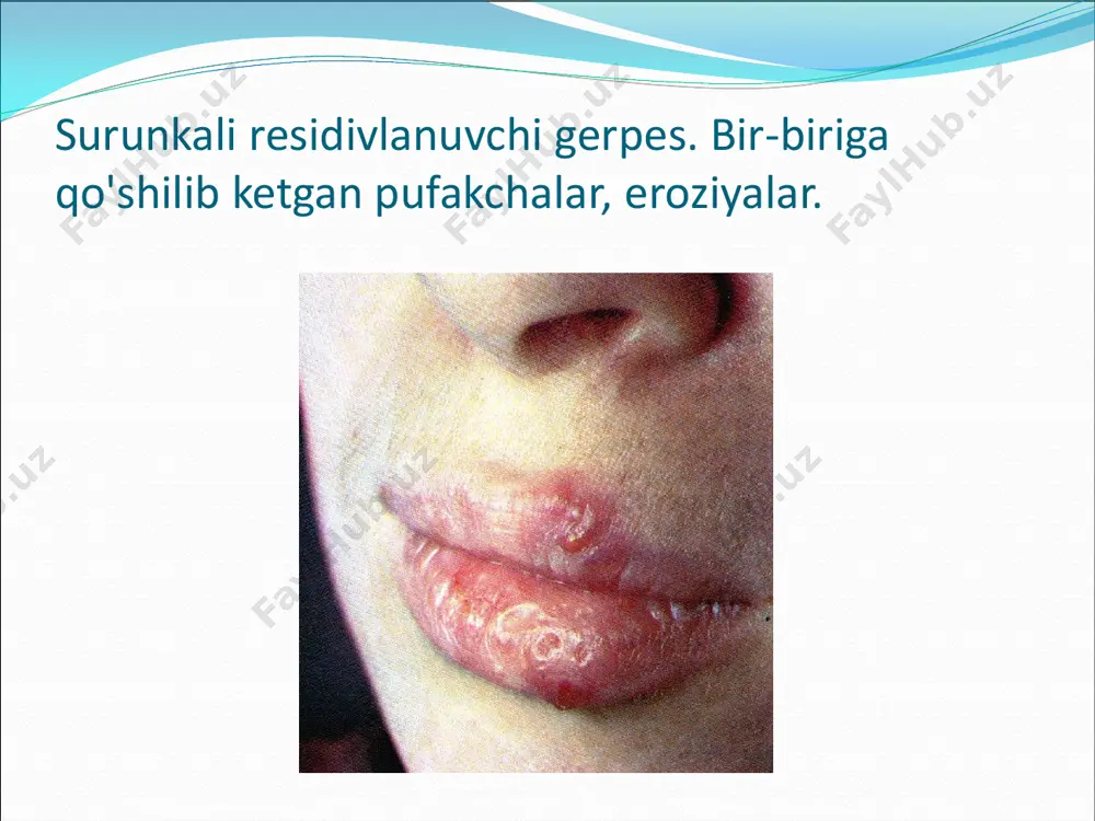 ydo bo'ladi. gripp. yumshoq tanglayning giperemiyaga uchragan shilliq qavatidagi puffak va eroziya. virusli so'gallar (borodavki) (verrucae vulgaris at plana). bu kasallik viruslarni lokal jaroxatlashidan vujudga keladi. odatda teri shikastlanadi, lekin ba'zan og'iz bo'shlig'ida ham o'zgarishlar yuzaga keladi. bunday so'gallar ko'p sonli bo'lib, lablarda, milkda va qattiq tanglayda aniqlanadi. virusli so'gallar (borodavki) (verrucae vulgaris at plana). bunday o'zgarishlar bemorni bezovta qilmaydi, ammo ba'zida ular xosil bo'lgan soxalarda qichishish va og'riq yuzaga keladi. virus so'gallar so'gallar o'lchamlari katta bo'lmagan, shilliq qavat yuzasidan bo'rtib turuvchi xosilalardir. virusli so'gallar. lab va tilning uchidagi ko'p sonli so'galli o'zgarishlar suvchechak.  teridagi toshmalar bilan birgalikda, til, tanglay va boshqa soxalarda pufaklar paydo bo'ladi. suvchechak.  pufaklar o'rnida og'iz bo'shlig'ida eroziyalar xosil bo'ladi, yuz va tana terisida qattiq po'stloqlar paydo bo'lib, ular iz qoldirmay tushib ketadi. botkin kasalligi (virusli gepatit).  ko'z skleralaridagi sariqlik bilan birga, kasallikni 2- 3 kunlari og'iz bo'shlig'i shilliq qavatida ham sariqlik paydo …