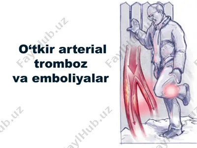 o‘tkir arterial tromboz va emboliyalar — PPT
