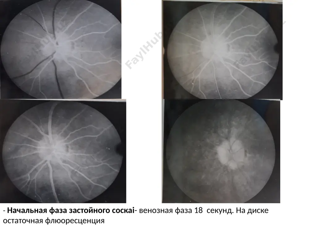 классификация заболеваний зрительного нерва - Page 5