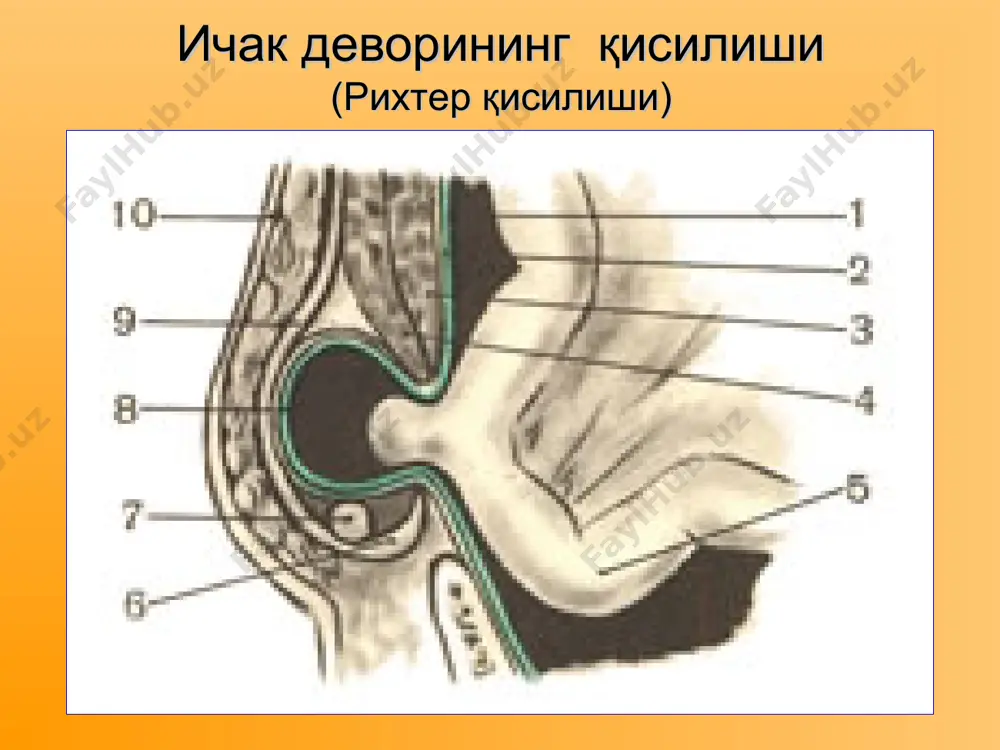 қорин чурраларининг асоратлари - Page 5