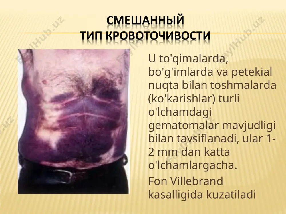 og'irligi (<1 / <2%) mutatsiya turi millati oldindan davolash (pnp, davolanmagan bemorlar) terapiya rejimi pup bilan istiqbolli ishlarda inhibitorlarning paydo bo'lish chastotasi необходимость в сравнительных и рандомизированных исследованиях! nogomogen tadqiqotlar dizayni istiqbolli / retrospektiv inhibitor chastotasi va sinov usuli turli xil kuzatuv vaqti / har bir bemorga bir / ko'plab dorilarni qo'llash * 5 1 ilgari davolanmagan bemorlarda (anp) inhibitor shakllanishining chastotasi: germaniya tromboz va gemostaz jamiyati (gth) проспективное мультицентровое исследование предварительные результаты : март 2005 число включенных в исследование пациентов с гемофилией a на 05.2005 : 154 w. kreuz. 5th wfh global forum on the safety and supply of treatment products for bleeding disorders september 24/25, 2007; montreal, canada quyidagi parametrlar baholanadi: f viii preparatni birinchi qabul qilish paytida va inhibitorlar hosil bo'lish davrida inhibitori shakllanishidan oldin viii preparatni qabul qilish kunlarining soni terapiya rejimi (profilaktika yoki talab bo'yicha) f viii dorining turi va dozasi gemofiliyaning og'irligi mutatsiya turi …
