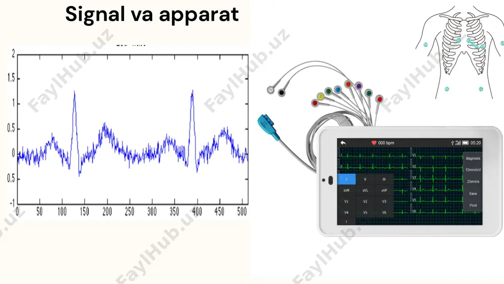 gacha taxminiy va batafsil koeffitsientlarga ajratadi. asosiy signalni driftsiz topish uchun driftning asosiy chizig'iga tegishli hisoblangan koeffitsientlar chiqarib tashlandi va signal idwt yordamida qayta tiklandi. klassifikatsiyalash yig'ilgan ekg signalining xarakteristikalari turli tasniflash usullari yordamida tasniflangan va tan olingan. yozilgan ekg signalining har bir zarbasi uchun hisoblangan avtoregressiv parametrlarni o'z ichiga olgan ko'p o'lchovli matritsalar bu ishning o'ziga xos xususiyati hisoblanadi. k-eng yaqin qo'shni usuli soddaligi tufayli bioinformatika va boshqa sohalarda eng ko'p qo'llaniladigan yondashuvlar qatoriga kiradi, ammo tegishli o'lchov o'lchovlari sifatida k tartibi modelini tanlashda e'tibor berish kerak. ushbu tadqiqotning keyingi bosqichida bemorning xususiyatlarini aniqlaydigan elektrokardiografiya boshqa bioinformatikada qo'llaniladigan chiziqli (lda) va kvadratik (qda) diskriminant tahlili tasniflagichlari yordamida ko'rib chiqildi va baholandi. p va t cho’qqilarni aniqlash fusion algoritm yordamida ekg signal cho’qqilarini aniqlash fusion algoritm r cho’qqilarni aniqlash . aritmiyalarni aniqlash taklif etilgan sxemaning samaradorligini baholash uchun uch xil turdagi ekg signallarini o'z ichiga olgan ekg natijalari to'plami ishlatilgan. …