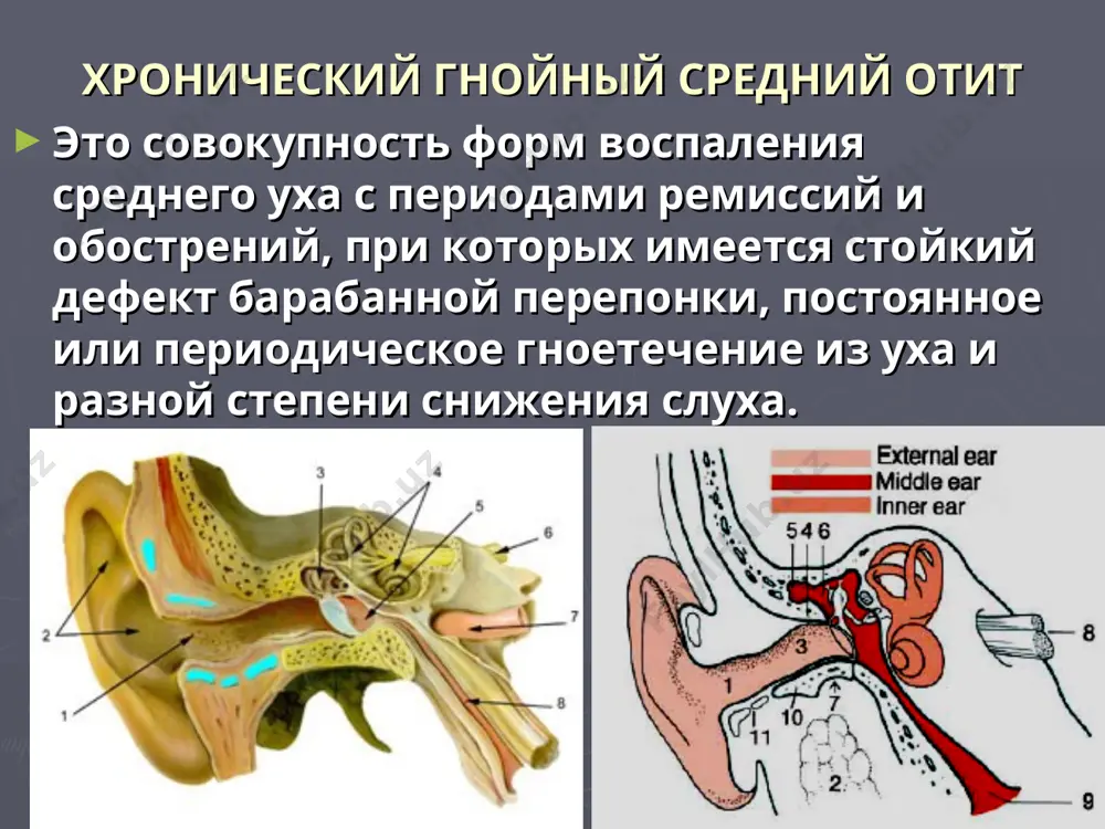 в патологический процесс втягивается слизевая оболочка среднего и нижнего отделов барабанной полости, слуховой трубы. это есть относительно доброкачественная форма отита, поскольку мезотимпанит может перейти в эпитимпанит и приобрести «злокачественную форму». перфорация барабанной перепонки при этой форме отита расположена в ее центральной, натянутой части. центральная перфорация – это дефект барабанной перепонки между краем которого и костным барабанным кольцом имеется остаток барабанной перепонки. по форме перфорация может быть круглая, овальная, почковидная разной величины. жалобы больные жалуются на выделение из уха и сниженный слух, редко шум в ухе. выделения при этой форме отита слизистые, слизисто-гнойные. при мезотимпаните слизевая оболочка утолщена, могут быть грануляции. большая грануляция имеет название ушного полипа. полип может быть большим, выходить во внешний слуховой проход и даже его обтурировать. это приводит к задержке гноя в полостях среднего уха и может вызывать развитие осложнений. слух страдает по типу поражения звукопроводимого аппарата. степень приглуховатости зависит от расположения и размера перфорации. при хроническом …