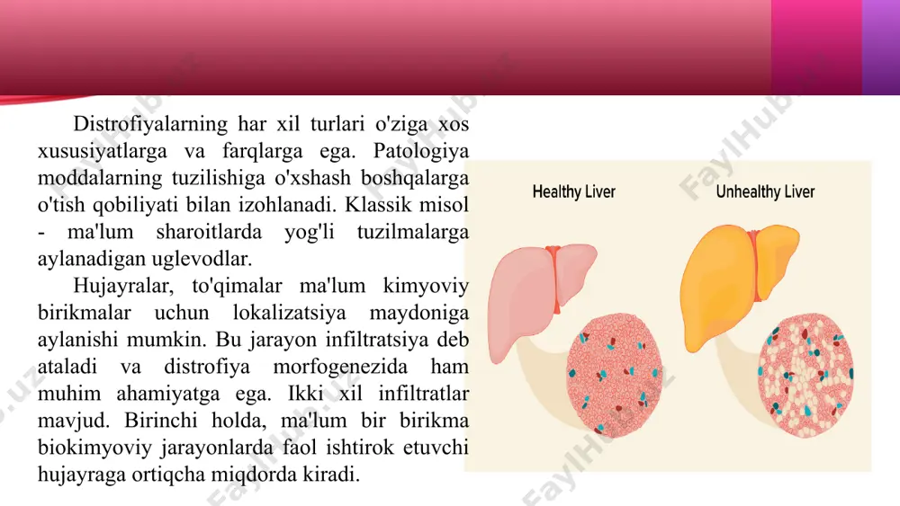 distrofiya bir nechta omillarga bog'liq bo'lib, sabablarni yuqumli va zaharlanishga bo'lish odatiy holdir. agar yurakda distrofiyaning bu turi rivojlansa, organ biroz kattalashadi va miyokard xiralashgan bo'lib qoladi, vizual ravishda kesilganda qaynatilgan go'shtga o'xshaydi. gistologik tahlil bazofiliyani ko'rsatadi. miyokard to'lqinlari eozin, gematoksilinga turlicha reaksiyaga kirishadi. gematoksilin tufayli ba'zi elementlar lilak rangga ega bo'ladi, boshqalari eozin tufayli yorqin ko'k rangga aylanadi. bunday patologiyaga ega bo'lgan jigar odatdagidan biroz kattaroqdir. organik to'qimalarni kesib o'tganda, soya loyga o'xshaydi. gistologik tahlil davomida oqsil donalari o'rnatilishi mumkin, ammo ularning mavjudligi doimiy bo'lmaydi. nur strukturasining yaxlitligini baholash muhimdir. proteinlar gepatotsitlarga bo'linish bilan tavsiflanadi, buning natijasida bu holat jigar nurlarining diskompleksatsiyasi deb ataladi. ushbu shakl ko'pincha buyraklar va jigarda lokalizatsiya qilinadi. vizual ravishda organdagi o'zgarishlarni sezish mumkin emas, mikroskop ostida tekshirilganda hujayra sitoplazmasida oqsil tomchilarini topish mumkin. distrofiya koagulyatsiya nekrozi tufayli hujayra o'limiga sabab bo'ladi. buyraklarda patologiya odatda turli kasalliklarga xos bo'lgan nefrotik sindrom tufayli shakllanadi. ko'pincha sindrom …
