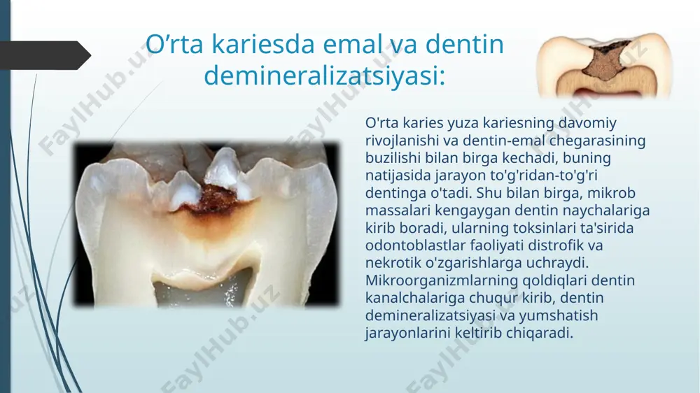 paning dentin qavatini minerilizatsiyasini kuchaytirishi. yallig’lanishga qarshi, antimikrob va odontatrop tasirga ega bo’lishi. ikkilamchi dentin xosil bo’lishini jadallashtirish kerak. ajratuvchi taglik qo’yish o’rta kariesda ajratuvchi taglik qo’yish –dentin va pulpa to’qimasini plomba ashyolarining tarkibiy qismidagi toksik moddalar saqlash, va yana plombalarga nisbatan adgezivlikni kuchaytirish uchun qo’llaniladi. ajratuvchi taglik sifatida turli xildagi sementlar qo`yiladi (fosfat-sement, visfat sement, adgezor, tenet, unifas, shisha ionomer sementlardan: fuji-1, fuji-2, ketakmolar va boshqalar). ajratuvchi taglikni qo`yishdan ko`zlangan asosiy maqsadlar- bu dentin va pulpa to`qimasini plomba ashyolarining tarkibiy qismidagi toksik moddalar ta'siridan saqlashdan iborat bo`lsa, yana ba'zi plomba ashyolarida (amalgama, gallodent va boshqalar) issiq va sovuq ta'sirlovchilar ta'sirini mo`'tadillashtirishdir. yana ularning bir xislati - bu plombalarga nisbatan adgezivlikni kuchaytirish hamda karies tubi va devorlarida plomba ashyosini mustahkamlash uchun tayanch nuqtasini hosil qilishdan iboratdir. ajratuvchi taglikni yupqa qavat qilib karies bo`shlig’ini tubi va devorlari bo`ylab, dentin emal chegarasigacha qo`yiladi, bunda karies bo`shlig’i konfiguratsiyasi saqlanib qolinishi zarur, hamda charxlangan …