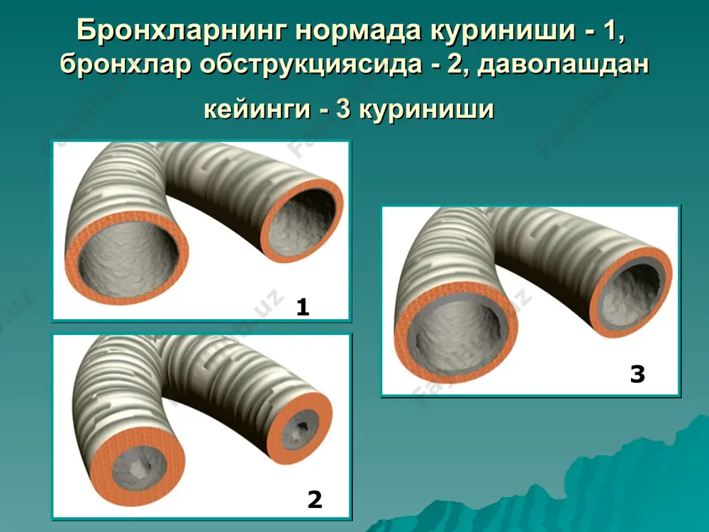 смлар 3. аспирация касалликлари 4. юрак кон-томир тизими касалликлари (ютн, норевматик кардитлар) 5. марказий ва периферик асаб тизими касалликлари 6. тугиа модда алмашинуви бузиилиши касалликлари 7. иммун етишмовчилик холатлари 8. кам учрайдиган касалликлар (симптом пиперс ва бошка) 9. бошка касалликлар (травмы, куйиш) бронхиал астма (ба) - бронхлар шиллик каватининг шиши, гиперсекрецияси , бронхоспазм оркасида келиб чикувчи бронхлар обструкцияси билан кечувчи сурункали аллергик касалликдир ("болаларда бронхиал астма" миллий дастури, 1997- мп “бад”). * бронхиал астма таркалиши сабабпари: - атмосфера хавосининг ифлосланиши. - турар жой хоналар экологиясининг ёмонпашуви, - oвкaтлaнишдa саноат консервантлари ва "ичимлик" ларнинг куплаб ишлатилиши (ксенобиотиклар) . - перинотал паталогияларнинг купайиши. - сунъий овкатлантиришнинг купайиши. - тамаки чекишнинг купайиши. - антибиотикларни кенг кулланилиши, вакциналарни норационап куллаш. - овкатланишда витамин ва микроэлементпар камомати. хомиладор аёппарнинг яхши овкатланмаслиги. улим сабаблари: ба нинг огир ва тез-тез кайталаниши анамнезда астматик холатнинг кайталаниши ва упка сунъий вентиляциясини такрор куллаш. стероид препаратларга моиллик. ба нинг эпилепсия …