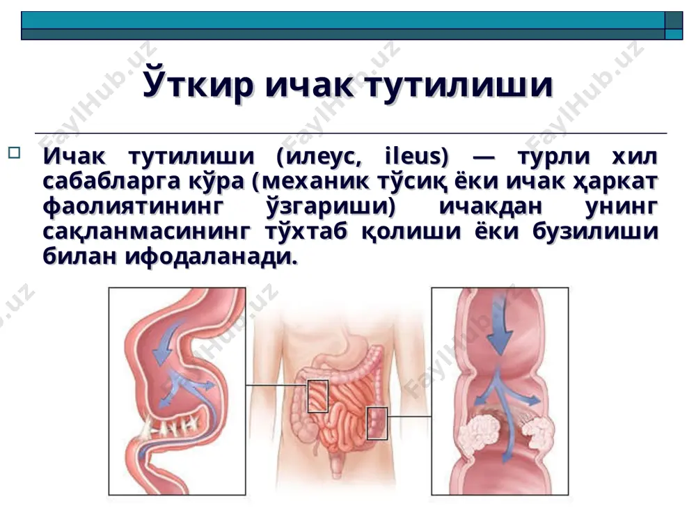 я морфофункционал табиатига кўра: 1. динамик (функционал) ичак тутилиши - спастик; - паралитик. 2. механик ичак тутилиши - странгуляцион (буралиб қолиш, тугун тушиши, ички қисилиш); - обтурацион (ўсма, ёт жисм, нажас тошлари ёки ўт тоши, аскаридалар тўпи, копростаз, ичакни ташқаридан эзилиши); - аралаш турлари (инвагинация, битишмали ичак тутилиши). тўсиқ даражасига кўра: 1. юқори – ингичка ичак тутилиши 2. пастки – йўғон ичак тутилиши келиб чиқишига кўра: - туғма - орттирилган ичак бўшлиғи тўсилиши даражасига кўра: - тўлиқ - қисман клиник кечиши бўйича: - ўткир; - сурункали * келтириб чиқарувчи омиллар: ривожланишнинг туғма аномалиялари – диафрагма, қорин олд ва орқа деворлари суст қисмлари, дефектлари; долихосигма, ичакнинг тўлиқ бўлмаган айланган холати, қорин парданинг қўшимча бурмалари, қорин бўшлиғи «чўнтаклари», қон томир мальформацияси; орттирилган омиллар - битишмалар, чандиқли деформациялар, ёт жисмлар, яллиғланиш касалликлари оқибатлари ва б. амалга оширувчи омиллар: овқат юкламаси ортиши натижасида ичак перистальтикасининг кучайи кетиши, ичак медикаментоз стимуляцияси, оғир жисмоний юкламадан сўнг …