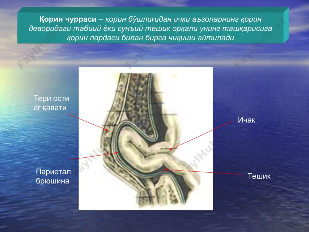 ritoneum; 2 - fascia transversalis; 3 – чурра қопи; 4 – кўр ичак девори. сирпанувчи чурра сирпанувчи чуррани ҳавфли томони – чурра қопи ўрнига ички аъзони кесиб қўйиш мумкин чуррани даволаш консерватив - бандаж тақиш хирургик чақалоқларда жаррохлик йўли билан даволашга қарши кўрсатма бўлганда қарши кўрсатмалар: оғир ҳамроҳ касалликлар бандаж тақишни манфий томонлари қорин девори тўқималарини атрофияси чурра таркибидаги аъзо ва чурра қопи билан орасида бирикмалар ҳосил бўлиши чурра дарвозаси ўлчамларини катталашиши тери мацерацияси ноқулайликлар тўғриланувчи чурраларда жарроҳлик амалиётни этаплари кесма чурра қопини ажратиш чурра дарвозасини кенгайтириш чурра қопини очиш чурра қопини олиб ташлаш чурра дарвозасини пластикаси чов чуррасидаги кесма киндик чуррасидаги кесма 1- по сапежко 2- по мейо 3- по лексер чурра қопини ажратиш чурра дарвозасини кенгайтириш чурра қопини очиш ва чурра махсулотини қорин бўлиғига киритиш чурра қопини олиб ташлаш чурра дарвозасини пластикаси чуррани олдини олиш чақалоқларни гигиенасини олиб бориш - киндикни гигиенаси, туғри овқатлантириш, ич келишини меъерга олиб …