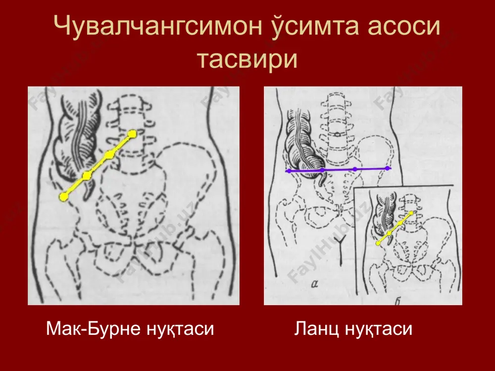 исқа) лапаротомияга талаблар 2. кам шикастлилик: а) мускул-апоневроз қаватларни: мускулларни толалари йўналиши бўйича ажратиш (кўндалангига кесмаслик) “ўзгарувчан” кесимлар – масалан, мак бурней-волкович-дьяконов операциядан кейинги чурра кам, жароҳат яхши битади б) томир-нерв тутамларини сақлаб қолиш нервлар шикастланса - мускуллар атрофияси, операциядан кейинги чурра вужудга келади. лапаротомияга талаблар мускул-апоневрозларни томир-нерв тутами йўналиши бўйича кесиш; 2 тадан ортиқ ёнма-ён нервни кесмаслик лапаротомияга талаблар боғлиқ: деворнинг қалин (кўп қаватли) ёки юпқа (кам қаватли) жойларига кесим жойида катта қон томирлар борлигига 3. кесимнинг оддийлиги ва тез ўтказилиши. лапаротомияга талаблар 4. лозим бўлганида кесимни узайтириш имконияти (аъзоларнинг атипик жойлашувида, ўсманинг ўсиб кетиши) 5. операция жароҳатининг ишончли бекилиб яхши битиб кетиши. чандиқ узунаси бўйлаб унга таъсир қилувчи тортиш кучлари перпендикуляр бўлмаслиги кесимлар таснифи умумий (универсал) кесимлар – деярли барча аъзоларни очиш мумкин; махсус кесимлар – айрим аъзо ёки аъзо гуруҳларига очиб кириш йўналишига кўра: бўйлама қийшиқ (ридел-кохер, мак бурней-волкович) бурчакли (комбинацияланган) – рио-бранко, федоров, ильин кесимлари кўндаланг …