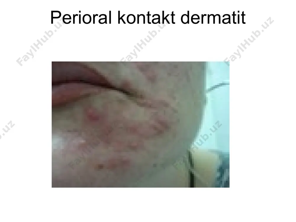 dermatitlar - Page 5