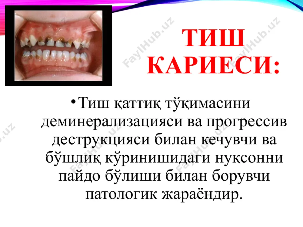 ағ тизимини шаклланиш давридаги, доимий тишларни ёриб чиқиш давридаги холади. тиш кариесининг кўп омилли модели инсон: эмаль кристаллари структураси, минераллари; сўлак хажми ва сифати; иммунитети; одатлари микроорганизмлар: s.mutans, lactobacilli ва бошқа бактериялар атроф муҳит: тиш карашини миқдори ва сифати, ферментлар ва минераллар, бактериялар, химоя омиллар, маданият. кариес касаллигини келтириб чиқарувчи бирламчи омиллар: тиш тўқимасини кариесга мойиллиги; тиш пилакчаси; кариесоген омиллар билан доимий алоқа. тиш пилакчаси ёпишқоқ структурали бўлиб, бактериал хужайра ва хужайралараро модда (матрица)дан иборат. милк усти карашлар – кариес чақирувчи омил; милк ости карашлар – пародонт касаллигини чақирувчи омил. тиш карашининг ривожланиш фазалари: 18 1-фаза: (1-2 кун) милк билан чегараланган тиш юзаси бактериялар билан қопланади. улар мавжуд бактерияларга ёпишади 2-фаза: (3-4 кун) карашнинг юза қавати гр+ таёқчалар қавати билан қопланади ва қалинлашади 3-фаза: (4-7 кун) караш милк остига ўтиб, бактерия ва уларнинг метаболитлари милк эгатига циркуляцияланади. 4-фаза: (7-11 кун) патоген бактерия тури ортади, милк эгати тўлиб боради. кариес патогенези …