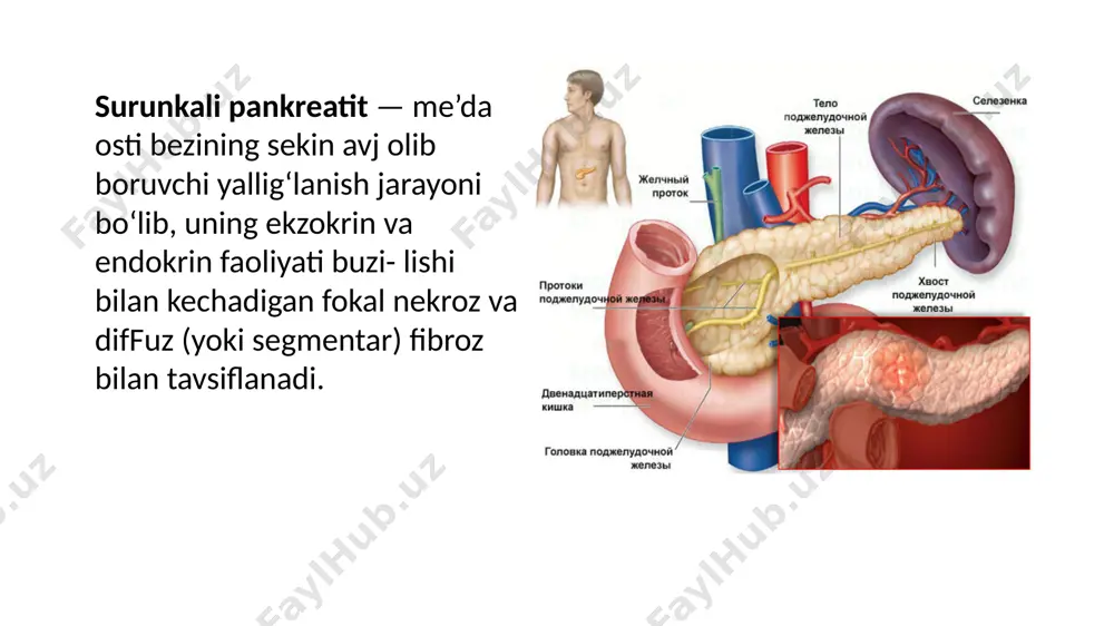 i (1982-yil): etiologiyasiga ko‘ra: birlamchi pankreatit ikkilamchi pankreatit morfologik belgisiga kolra: shishli shakli sklerotik-atrofik shakli fibroz (diffuz va diffuz tugunli) shakli psevdokistoz shakli kalsifikatsiyalangan shakli klinik belgilarning xususiyatiga kolra: polisimptom shakli og‘riqli shakli psevdoo'smali shakli dispeptik shakli latent shakli kasallikning bosqichlariga kolra: remissiya qo‘zish davri kasallik kechishiga kolra: yengil darajadagi pankreatit (i boshlang‘ich bosqich) o‘rta og‘ir darajadagi pankreatit (ii bosqich) og'ir darajadagi pankreatit (iii bosqich, terminal, kaxeksik). klinikasi surunkali pankreatitning klinik manzarasi og'riq va dispepsiya sindromi hamda ekzokrin va endokrin faoliyatning yetishmovchiligi belgilaridan iborat. obyektiv ko'rilganda: teri qoplamlarining quruqligi, glossit, stomatit (gipovitaminoz natijasida), tana vaznining kamayishi va paypasla- ganda me’da osti bezi sohasida og‘riq va frenikus belgisining musbatligi aniqlanadi og'riq sindromi. og‘riq ovqatdan (achchiq, qovurilgan,yog‘li) 40— 60 daqiqadan so'ng paydo bo'ladi. og‘riq o'tkir, asta-sekin kuchayib boruvchi yoki doimiy, to‘mtoq, ezuvchi tusda, ovqat yegandan so‘ngkuchayishi mumkin. og‘riq joylashuvi meda osti bezining zararlangan anatomik sohasiga bog'liq. chap qoviirg‘a ravog'i ostidagi og‘riq me’da …
