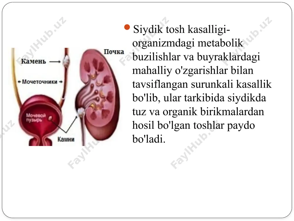 bo'lishining kolloid nazariyasiga ko'ra, siydik murakkab eritma bo'lib, erigan mineral tuzlar (kristalloidlar) bilan o'ta to'yingan va mayda oqsil moddalaridan (kolloidlar) iborat. ikkinchisi kristalloidlar bilan kimyoviy aloqada bo'lib, ularni sog'lom odam siydigida erigan holda ushlab turadi, ya'ni kolloid- kristalloid muvozanati hosil bo'ladi. agar siydikda kolloidlar va kristalloidlar o'rtasidagi miqdoriy va sifat munosabatlari buzilgan bo'lsa, patologik kristallanish va tosh shakllanishi mumkin. tosh paydo bo'lishining muhim omillaridan biri bu siydik reaktsiyasi (ph). u proteolitik fermentlarning optimal faolligini va siydik tuzlarining cho'kishini aniqlaydi.) siydik tosh kasalligining asosiy belgilari: og'riq o'tkir (buyrak kolikasi) yoki zerikarli, og'riqli bo'lishi mumkin. buyrak sanchig'ining sababi siydik yo'lini tosh bilan to'sib qo'yish natijasida buyrakdan siydik oqimining keskin buzilishidir. og'riq to'satdan, yengillik davrlari va takroriy hujumlar bilan. og'riq buyrak sohasida yoki siydik yo'li bo'ylab lokalizatsiya qilinadi va yonbosh va inguinal mintaqaga xos nurlanishga ega. bemorlar o'zlarini bezovta qiladilar, og'riqni kamaytiradigan tana holatini topa olmaydilar. zerikarli, og'riqli og'riqlar siydik tosh kasalligi fonida …