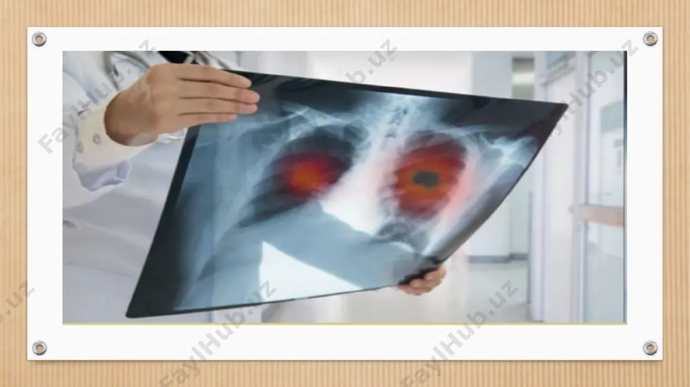 logik kasalliklar ichida eng ko‘p uchraydigan turlari – o‘pka, sut bezi, to‘g‘ri va ko‘ndalang chambar ichak, me’da, teri, jigar va prostata bezi saratonlaridir. klinik belgilari. oxirgi yillarda tuxumdon, sut bezi, og‘iz bo‘shlig‘i a’zolari, bosh miya, buyrak, siydik qopi o‘smalarining ko‘payishi kuzatilmoqda. bolalarda xavfli o‘sma kasalliklari 2,5-3 foizni (umumiy kasalliklar strukturasida) tashkil qiladi. onkologik kasalliklarni barvaqt bosqichlarda aniqlash imkoniyati haligacha yaratilmagan, bu esa o‘lim ko‘rsatkichi o‘sishiga olib kelmoqda. kasallikni erta aniqlashda uning dastlabki belgilari (simptomlari)ga e’tibor berish kerak. kasallik rivojlanishida klinik belgilar muhim axamiyatga ega. o‘sma jarayoni uzoq yillar rivojlanishini inobatga oladigan bo‘lsak, (10-20 yilgacha) va u 80 foiz bemorning to‘qimalarida o‘smaoldi o‘zgarishi yoki o‘smaoldi kasalliklaridan keyin rivojlanishi mumkin. shuning uchun o‘sma kasalliklarining o‘ziga xos belgilari kuzatilmaydi, bo‘lsa ham uni ilg‘ab olish qiyin. bundan tashqari, har bir a’zoning o‘ziga yarasha o‘smaoldi kasaliklari mavjud bo‘lib, ma’lum bir klinik ko‘rinishga egadir. xavfli o’smalarning klinik belgilari. xavfli o‘sma rivojlanishi uzoq davom etadigan jarayon bo‘lib, …