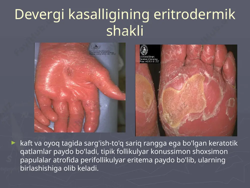 devergi kasalligining eritrodermik shakli - Page 4