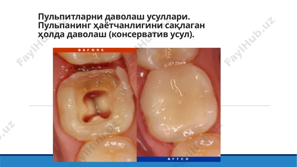 изи сўрилаётган сут тишлари ■ илдизи шаклланмаган доимий тишлар ■ анестезияни кўтара олмайдиган пациентлар тиш бўшлиғини очиш кариоз бўшлиқни чархлашнинг хамма босқичларини ўтказиш . кариоз бўшлиққа антисептик ишлов бериш. пульпа усти гумбази қолдиқларини олиб ташлаш, тиш бўшлиғини очиш антисептик остида тиш бўшлиғидан экскаватор ёрдамида путрид массани олиб ташлаш канал оғзини кенгайтириш буюм ойначасининг ғадир будир тарафига 2 томчи антисептиклар томизиш канални медикаментоз ювиш хлор сақловчи воситалар перикись водород йод сақловчи воситалар нитфуран қатори воситалари тўртламчи аммонийли бирикмалар карбамид протеолитик ферментлар илдиз каналини ювиш ва кенгайтириш standart усул step back - усули crown down - усули илдиз каналларига тиббий ишлов беришда қўлланиладиган суюқликлар endotine cresophene rockles 4 rockles 8 cresatine paramono-chlorphenol camphe mepacyl, solution osomol 4 solution d’acetate de metacresyle endosept iodo - glycerin camphor -phenol camphor –phenol- menthol - thimol jen – formo – cresol(buckley’s formocresol) jen - camphorcresol крезодент – суюқлиги метакрезол ацетат,парахлорфенол,этил спирти дексаметазон, парахлорфенол,тимол, эксципиент дексаметазон, формалин,фенол,гваякол …
