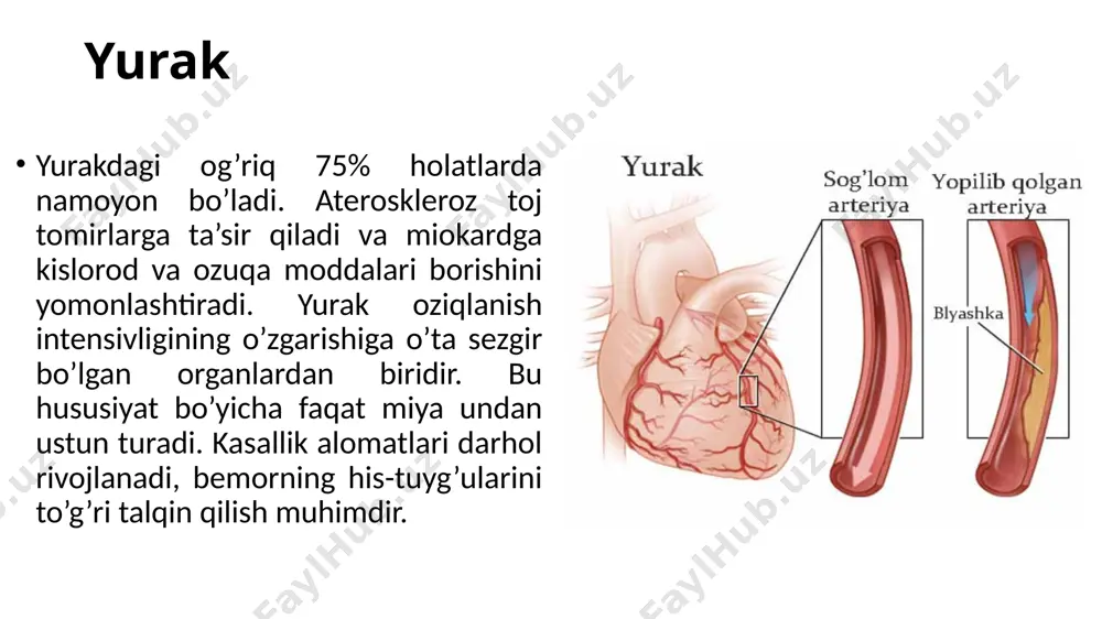 erak. biroq, xolesterin faqat me’yoridan ortiqcha bo’lganidagina aterogendir. ateroskleroz va qandli diabet kasalligi xolesterin me’da osti bezi hazm qildiruvchi shirasi va gormonlari sintezida faol ishtirok etadi va u qandli diabet rivojlanishining sababchisi bo’lmasa ham, uning kechishiga sezilarli darajada ta’sir o’tkazadi. qandli diabet qon tomirlarining aterosklerozi xavfini oshiradi (rivojlanish ehtimoli yarim baravar ortadi). bundan tashqari tomirlarning aterosklerozi diabet kechishini og’irlashtiradi. qandli diabet ishtirokida ateroskleroz kasalligi rivojlanishi xavfi erkaklarda ham, ayollarda teng darajada belgilanadi (agar diabet kasalligi bo’lmasa, ko’pincha erkaklar aziyat chekadi). ateroskleroz nimasi bilan xavfli? rivojlanish bosqichlari statistika ma’lumotlariga ko’ra, ateroskleroz yurak-qon tomir tizimining eng keng tarqalgan kasalligi va butun dunyo bo’ylab aksariyat bemorlar o’limining asosiy sababchisidir. ateroskleroz o’zgaruvchan bo’lib, kasallikning mohiyati qon tomirlari bo’shlig’ining torayishi yoki to’silishi bo’lishiga qaramasdan, u butun organizmga sezilarli darajada ta’sir qiladi. qon aylanishining yetishmasligi yurak, miya, qorin bo’shlig’i organlari, oyoqlar va qo’llarga (kamdan-kam) ta’sir qiladi. arteriyalarda qon aylanishining buzilishi kichik qon tomirlariga ham ta’sir qiladi, …
