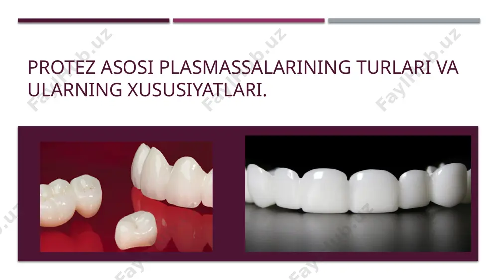 iz polimerlash mumkin. buning uchun massadagi benzoil peroksid molekulalarining kimyoviy yo'l bilan parchalanishini keltirib chiqarish zarur. shu maqsadda issiqlik omili rolini bajaradigan turli-tuman kimyoviy aktivatorlar sulfid kislotalarning tuzlari, dimetilparatoluidin, uchlamchi aminlar va boshqalar qoʻllaniladi. uy haroratida ularbenzoil peroksidni dissotsiatsiya qilish xususiyatiga ega. uy haroratida polimerlanadigan plastmassalar o'z-o'zidan qotadigan, deyiladi. o'z-o'zidan qotadigan plastmassalarning polimer kukunlari tarkibida benzoil peroksid miqdori 1 % atrofida, aktivator esa, monomerda 3 % miqdorida boʻladi. o'z-o'zidan qotadigan plastmassalar polimerlanishining o'z xususiyatlari bor: 1) polimerlanish tugallangandan so'ng massada 5 % gacha monomer qoladi, bu issiqlik ta'sirida polimerlanishga qaraganda 10 baravar ko’p; 2) hosil boʻladigan polimer zanjirlar issiqlik bilan polimerlanishdan ko'ra kaltadir; 3) o'z-o'zidan qotadigan plastmassaning polimerlanishida ko'pmiqdorda issiqlik ajralib chiqadi, bu massada teshiklar va chig'anoqlar hosil boʻlishini keltirib chiqarishi mumkin.ortiqcha issiqlikni yo'qotish uchun buyumlarni sovuq suvga solish tavsiya etiladi. bu, asosan, massiv buyumlarga taalluqlidir: polimerlanadigan massa hajmi katta boʻlganda koʻproq miqdorda issiqlik ajralib chiqadi; 4) polimerlanishning ayrim aktivatorlari …
