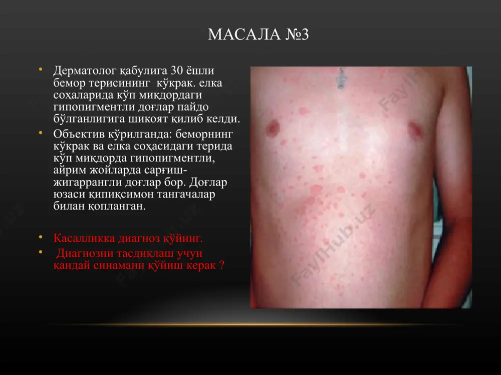 dagi xuddi shunday papulalar paydo bo'lgan. diagnozni aniqlang. in'ektsiya qilingan joyda paydo bo'lgan papula nimadan dalolat beradi? masala №12 shifokor qabuliga kelgan 50 yoshli bemor 3 yildan buyon kasal bo'lib, bo'ynining orqa yuzasi sohasida kasallik o'chog'i mavjud. ob'ektiv ko'rilganda: uning o'lchamlari 4x7 sm diametrda. kasallik o'chog'ida kuchli rivojlangan lixenifikatsiya, papulyoz infiltratsiya, ekskoriatsiya, gemorragik qaloqlar, giperpigmentatsiya, biroz qipiqlanish ko'zga tashlanadi. xuruj qilib turuvchi qichishish bezovta kilmoqda. qaysi kasallik haqida o'ylash kerak? kasallik o'chog'ida qaysi zonalarni tafovut qilish mumkin? masala №13 dermatolog huzuriga 15 yoshli bola otasi bilan kelib bilak, tirsak, boldir sohasida gavda, qorin terisida har-xil kattalikda muguz plastinkalar paydo bo'lganligiga shikoyat qildi. bola 3 yoshdan beri kasal. bu plastinkalar baliq tangachasiga o'xshab joylashgan. sub'ektiv – terining biroz taranglashishi mavjud. qaysi kasallik haqida o'ylash mumkin? qaysi dori preparati buyuriladi. masala № 14 shifokor huzuriga 40 yoshli ayol qo'l kaftlariga, panjalariga toshmalar toshishi, qichishishiga shikoyat qilib keldi. bemor bir necha yildan beri …