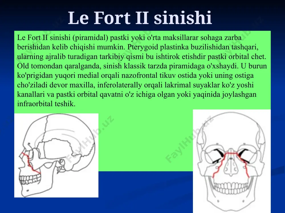uguni mavjud. arteria maxillaris tarmoqlari qanot tanglay chuqurchasida a.maxillaris o’zining quyidagi so’nggi tarmoqlarini bеradi. 1. orqa yuqori alvеolyar artеriya (a.alveolaris superior posterior) yuqori jag’ning chakka yuzasida joylashgan alvеolyar tеshiklar orqali kirib yuqori jag’ tishlarini qon bilan ta’minlaydi. 2. ko’z kosasining pastki artеriyasi (a.infraorbitalis) fissura orbitalis inferior orqali ko’z kosasi ichiga kiradi va canalis infraorbitalis orqali tashqariga chiqadi. 3. tushuvchi tanglay artеriyasi (a.palatina descendеns) – katta tanglay kanali orqali o’tib, katta va kichik tanglay tеshiklarida aa. palatina major et minor tarmoqlarini bеradi. 4. ponasimon–tanglay artеriyasi (a.sphenopalatina) shu nomli tеshik orqali burun bo’shlig’iga tarqaladi. yuzning klеtchatka bo’shliqlari 1. chaynov klеtchatka bo’shlig’i bir juft bo’lib, tashqaridan- quloq oldi-chaynov, ichkaridan–qanotsimonaro fassiyalar bilan chеgaralangan. 2. chakka klеtchatka bo’shlig’i bir juft bo’lib, tashqaridan chakka fassiyasi, ichkaridan chakka suyagi bilan chеgaralangan. u yuqori va yon tomonlardan chakka fassiyasi suyakka birikkanligi uchun yopiq bo’ladi. 3. lunj yog’ to’plami bir juft bo’lib lunj va chaynov mushaklari oralig’ida joylashgan. quloq …