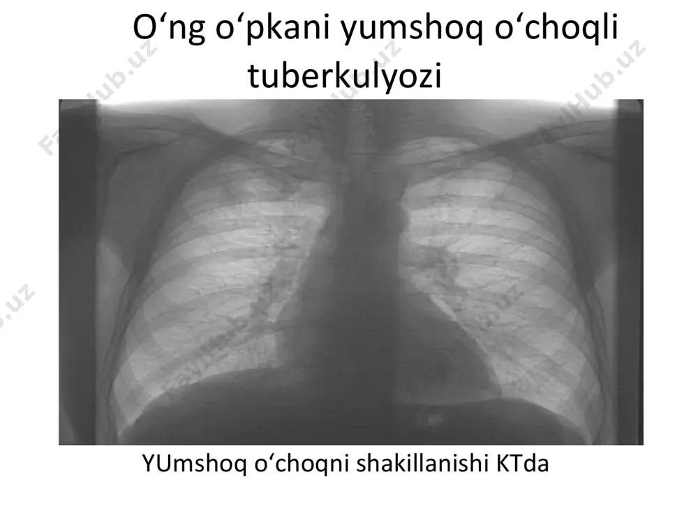 o'choqli tuberkulyoz infiltratsiya davri - Page 5