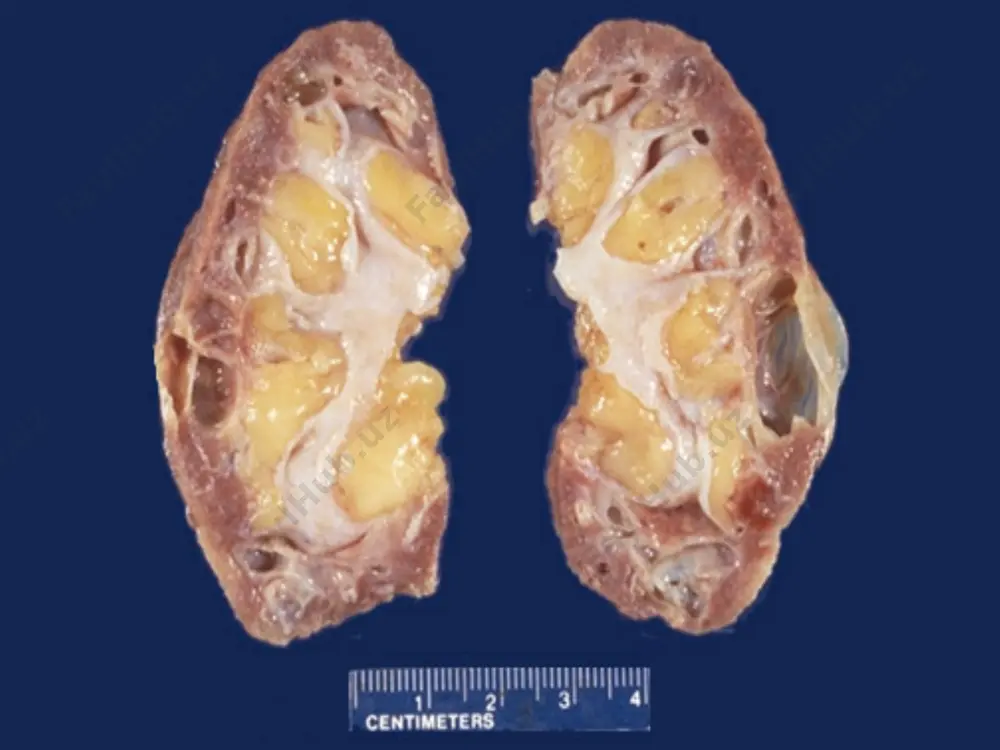 filtasiyasi - 30-40 ml/min. qon elektorlitlari – giponatriemiya kuzatilishi mumkin. metabolik asidoz-yuk. sbye tasnifi (davomi) intermittik bosqichi shikoyatlari: dispepsiya, chanqash, tez charchash, bosh og’rigi, uyqu buzilishi, kungil aynishi. diurez - kuchli poliuriya. gemoglobin – 67-83. mochevina – 10.1-19.0 mol/l. kreatinin - 0.3-0.6 mmol/l. koptokchalar filtasiyasi - 20-30 ml/min. qon elektorlitlari – giponatriemiya, gipokalsiemiya. metabolik asidoz – o’rta darajada rivojlangan. terminal bosqich darajasi i buyrakni suyuqlik ajratish funksiyasi saqlangan. koptokchalar filtrasiyasi: 10-15 ml/min. azotemiya. asidoz o’rta darajada. iia oligo-, anuriya, suyuqlik ushlanishi, diselektrlitemiya. giperazotemiya. asidoz. yurak-qon sistemasida o’zgarishlar boshlanadi. arterial gipertenziya. qon aylanish etishmovchiligi iia. iib iia bosqichidagi o’zgarishlar ogirroq ko’rinishi. qon aylanish iib. iii ogir uremiya, giperazotemiya (>285 mmol/l), diselektrolitemiya, asidoz dekompensasiyalangan. ogir yurak va qon aylanish etishmovchiligi, yurak astmasi hurujlari, anasarka, ichki organlar ogir distrofiyasi. klinikasi siydik konsentrasiyasining kamayishi sababli osmolyarligi qon osmolyarligiga teng bo'ladi. buyrak koptokchalarining filtrasiyasi hamda kanalchalarning reabsorbsiyasi pasayishi tufaylipoliuriya rivojlanadi va siydik bilan ko'p miqdorda …
